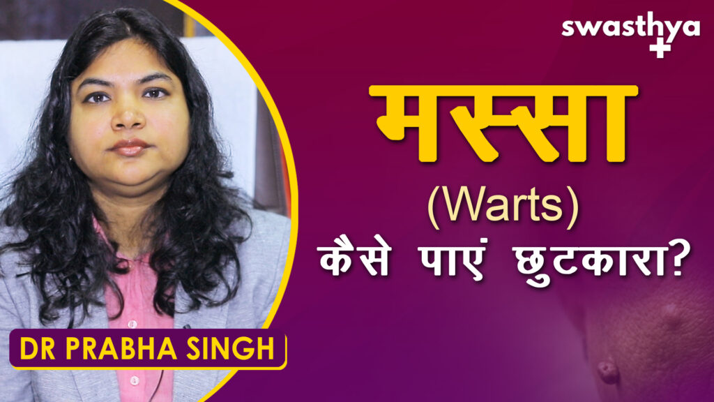 Prabha Singh_warts treatment in hindi