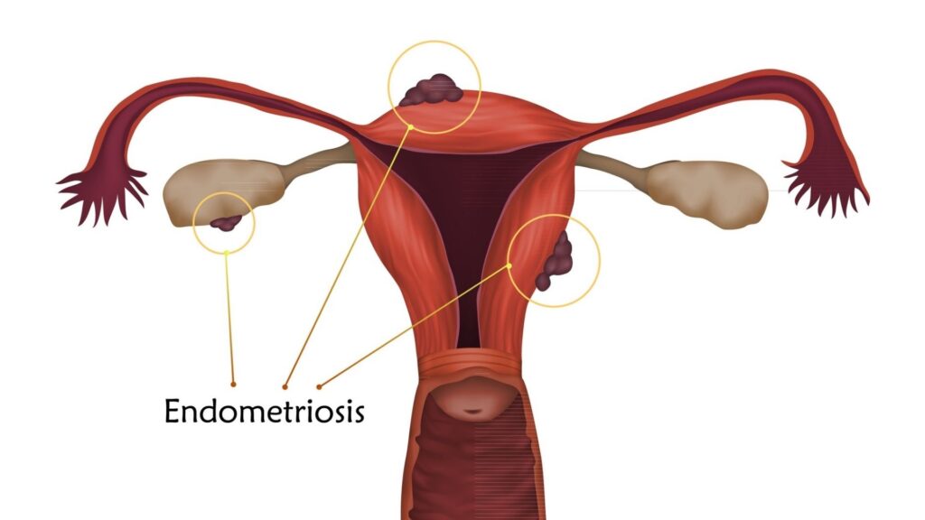 Endometriosis pain