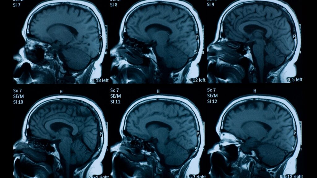 brain stroke_MRI