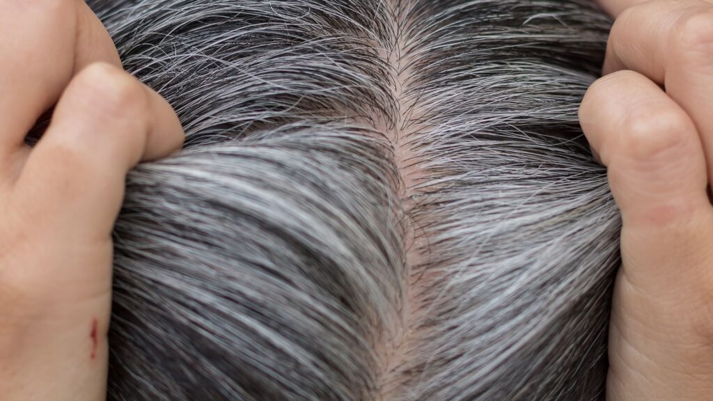 grey hair problem