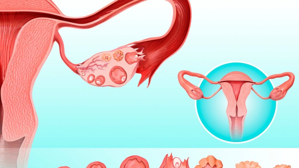 Ovarian Cyst treatment
