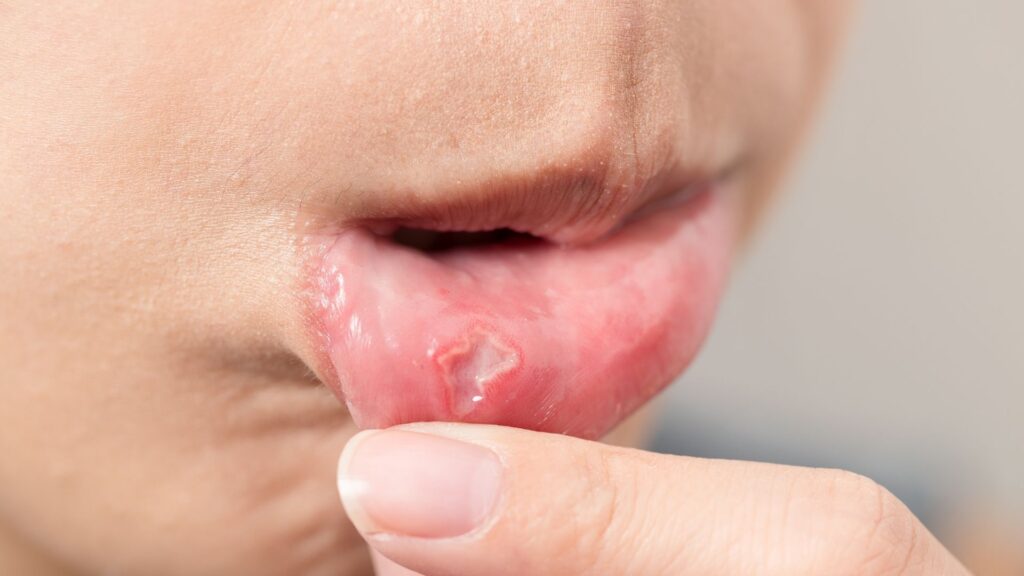 mouth ulcer