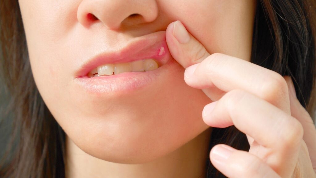 mouth ulcer pain